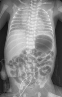 Abb.1.: Röntgen eines Neugeborenen mit Ösophagusatresie Typ IIIb. Die Magensonde liegt im blind endenden Ösophagusstumpg. Die Magenblse ist gefüllt mit Luft durch die Verbindung zum Trachealsystem.