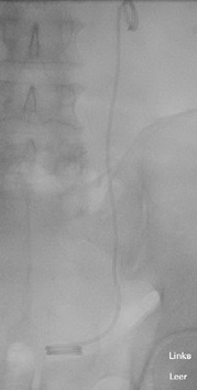 Röntgenbild DJ-Ureterschiene im Röntgenbild, Copyright: Klinik für Urologie/MHH