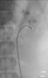Röntgenbild bei Verwendung eines flexiblen Ureterorenoskops, Copyright: Klinik für Urologie/MHH