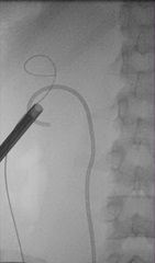 Röntgenbild einer PNL mit eingebrachtem Arbeitsschaft und platzierter Ureterschiene, Copyright: Klinik für Urologie/MHH