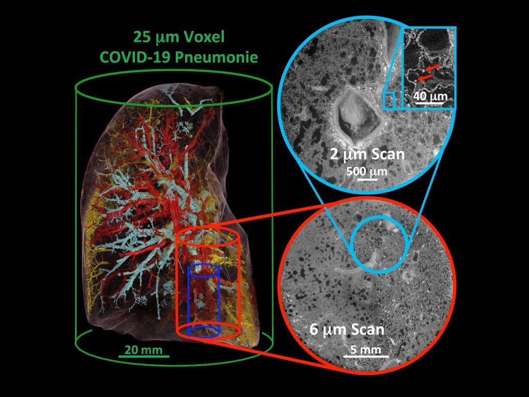 Three-dimensional segmentation and reconstruction of a lung with Covid-19 pneumonia. Individual thrombi (yellow), vascular changes (red) and airway changes (turquoise) can be visualised via the high-resolution method of Hierarchical Phase-Contrast Tomography (HiP-CT).