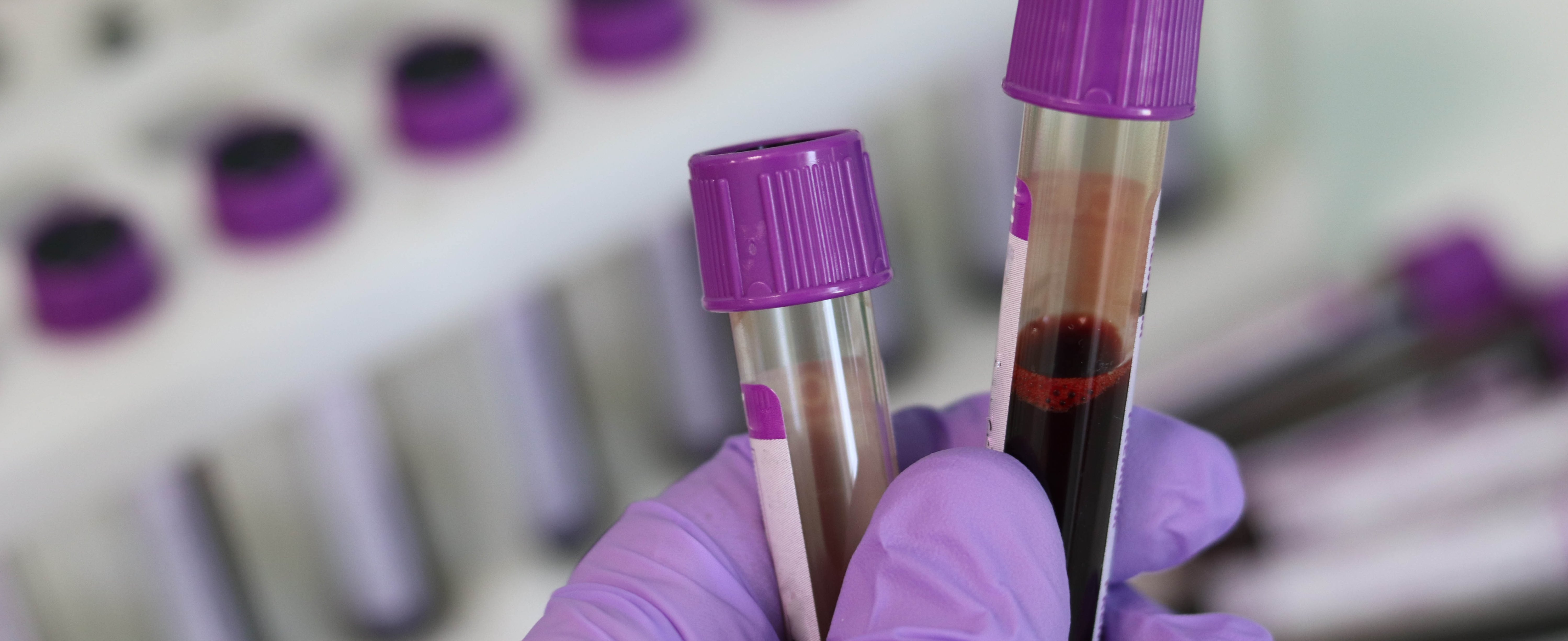 Laborröhrchen mit Blut Lila Handschuhe halten lila Laborröhrchen mit Blut