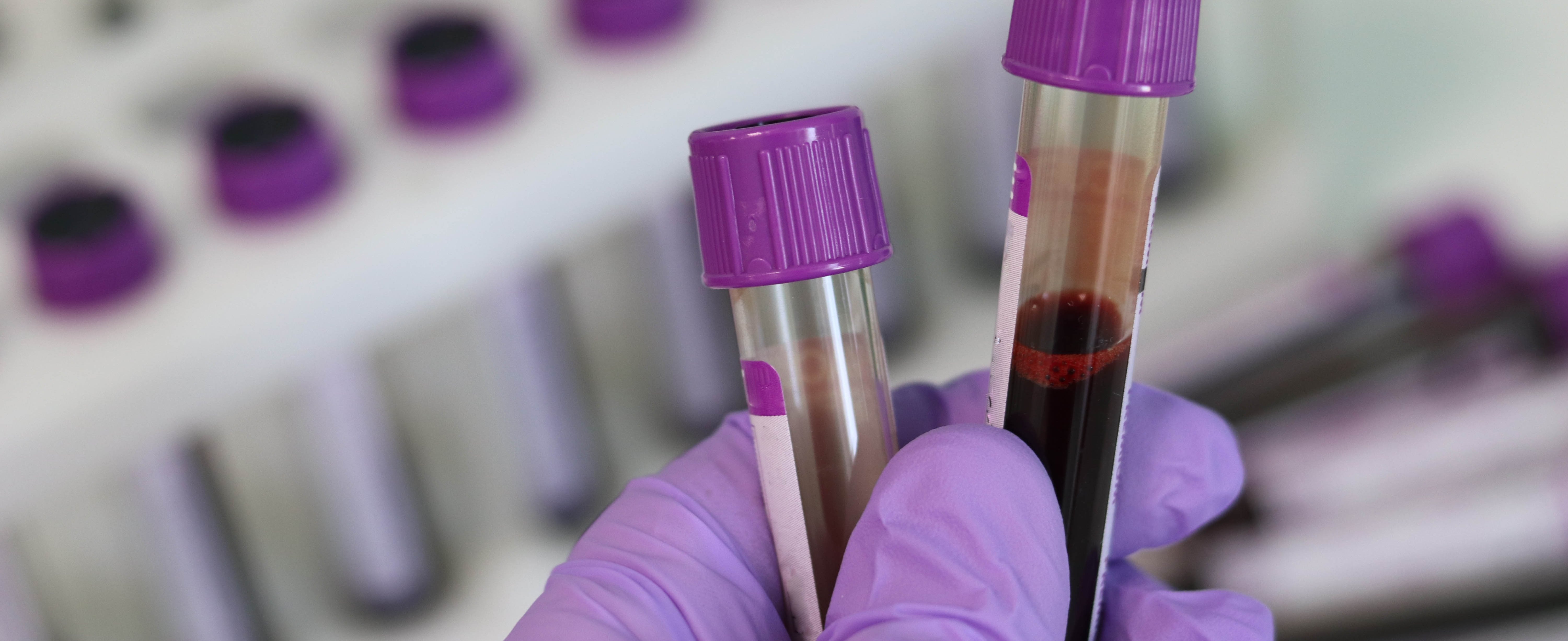 Lila Handschuhe halten lila Laborröhrchen mit Blut