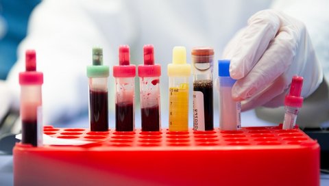 Blut- und Urinproben in verschiedenen Laborröhrchen stehen in einem roten Probenhalter, während eine medizinische Fachkraft eine Probe in den Halter stellt. 