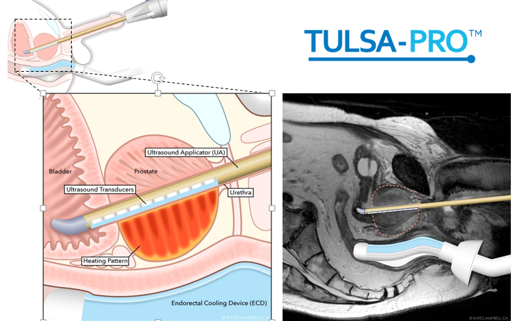 Fokale Therapie Fokale Therapie, Copyright: Klinik für Urologie/MHH