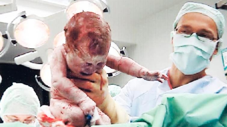 Prof. Hillemanns zeigt das Baby nach der Kaiserschnittgeburt im OP-Saal