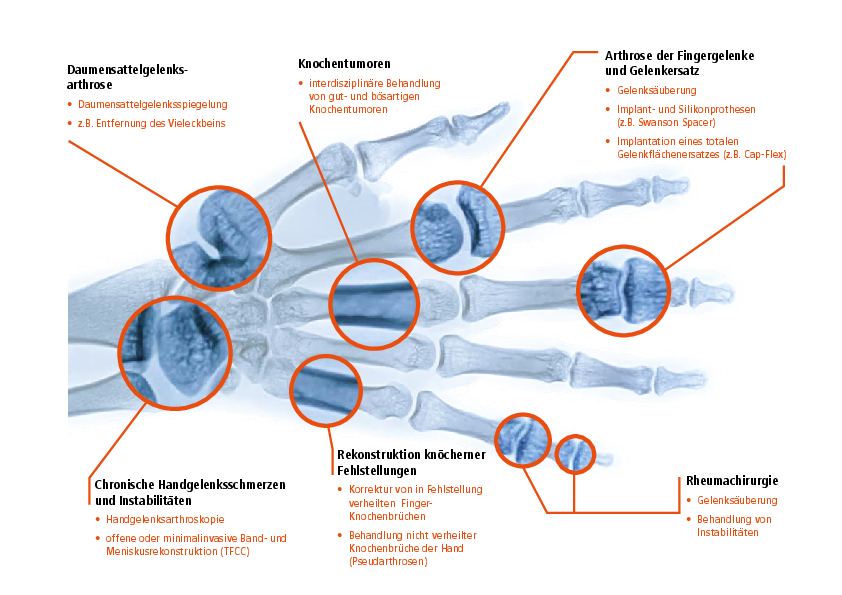 Schaubild Handchirurgie