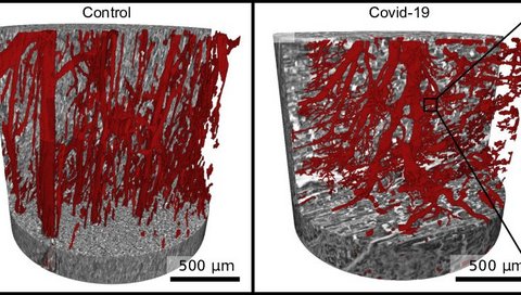 Zwei Grafiken zeigen Herzgewebe in gesundem Zustand (links) und bei schwerem Verlauf von Covid-19 (rechts) 