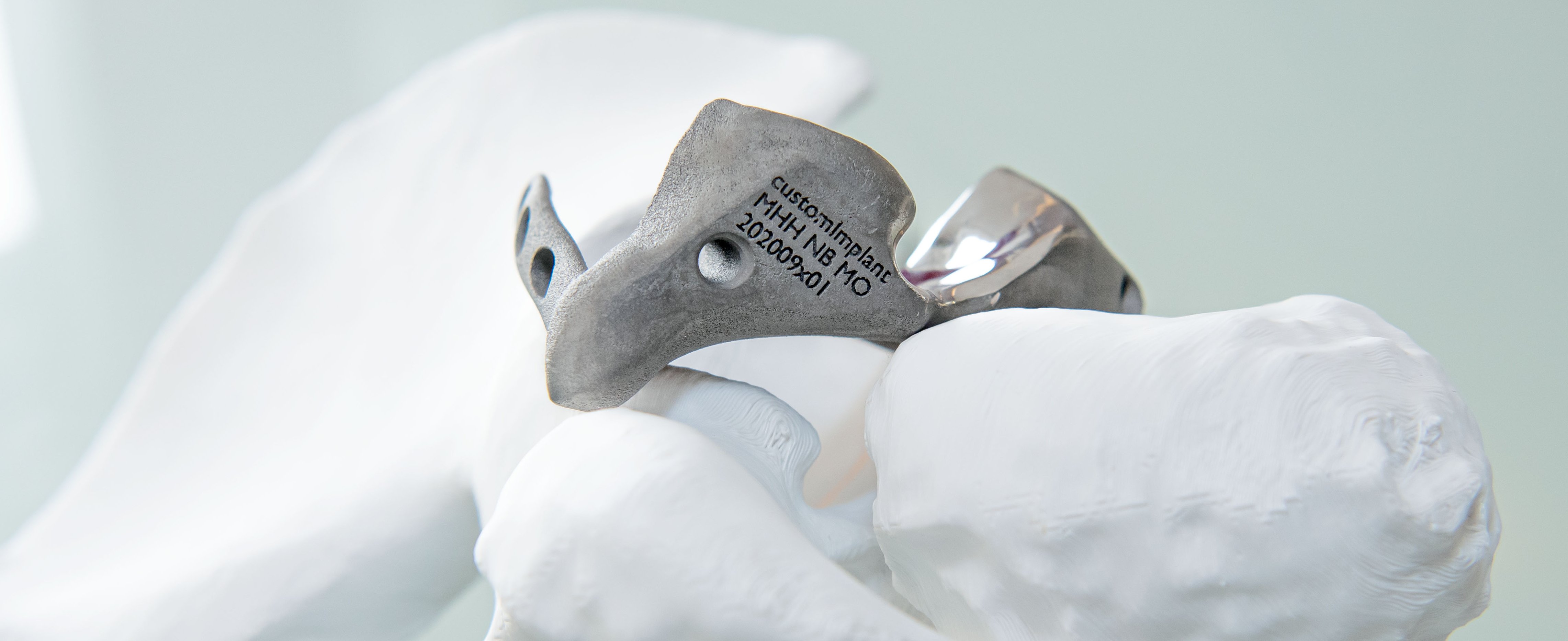 Ein 3D gedrucktes Implantat, das speziell für einen Patienten hergestellt wurde
