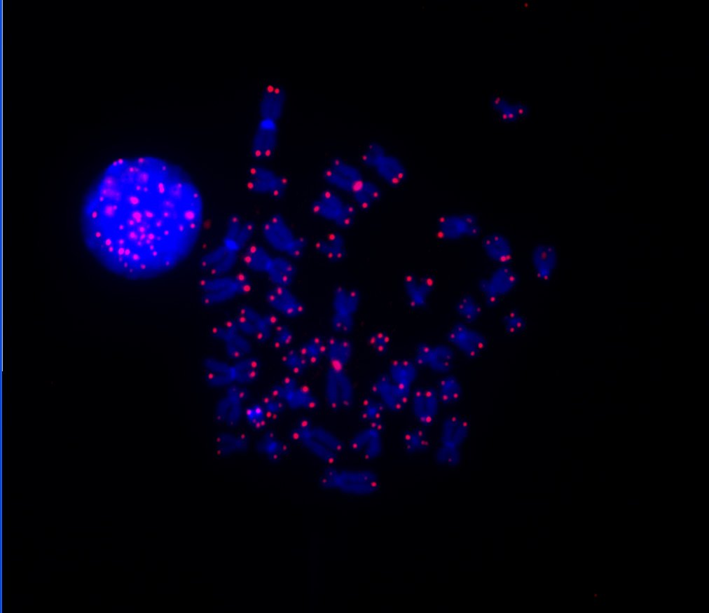 Telomerlängenbestimmung mittels T/C-FISH bei einem Patienten mit MDS