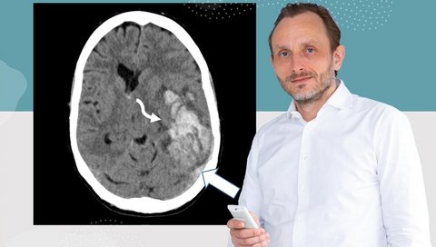 Professor Dr. Andreas Tiede mit der computertomographischen Aufnahme einer VITT-Patientin.