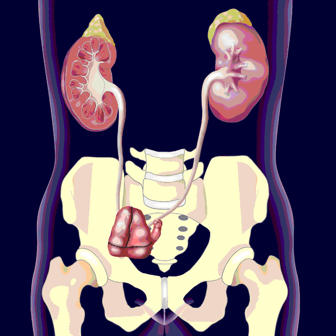 Harnableitung mittels Mainz I Pouch, Copyright: Klinik für Urologie/MHH