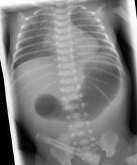 Röntgenbild eines Neugeborenen mit dem typischen Double Bubble Sign (Luftgefüllter Magen und proximales Duodenum mit luftleerem distalen Darm)
