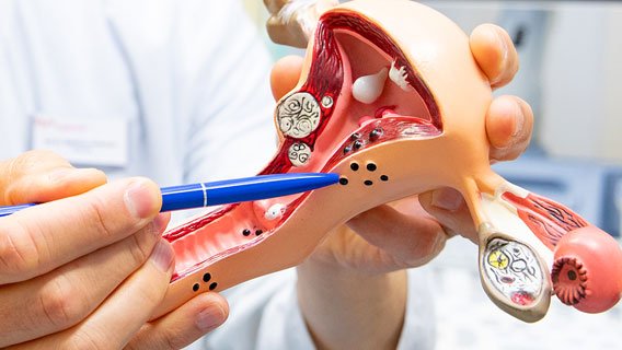eine Hand zeigt an einem Organmodell den von Endometriose betroffenen Bereich