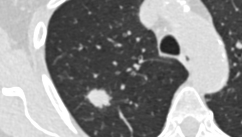 Low-dose CT scan of the lung.