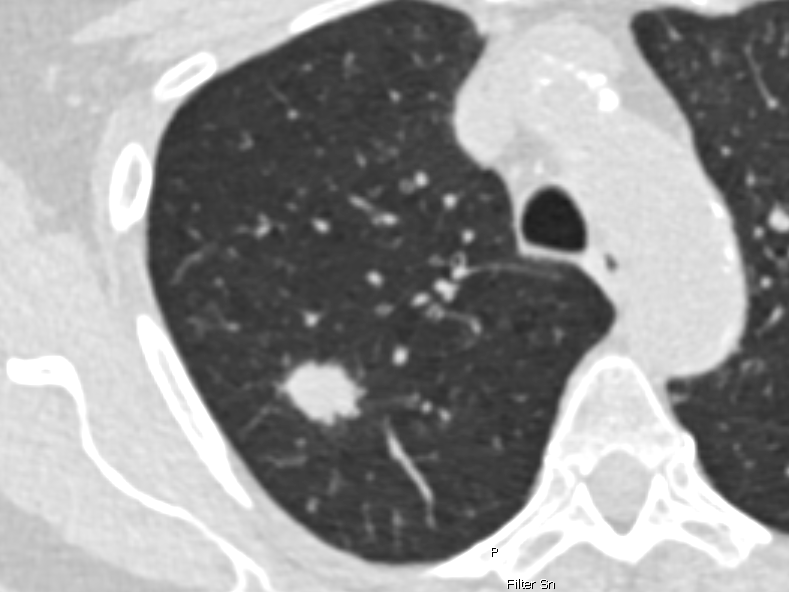 CT-Aufnahme einer Lunge. 