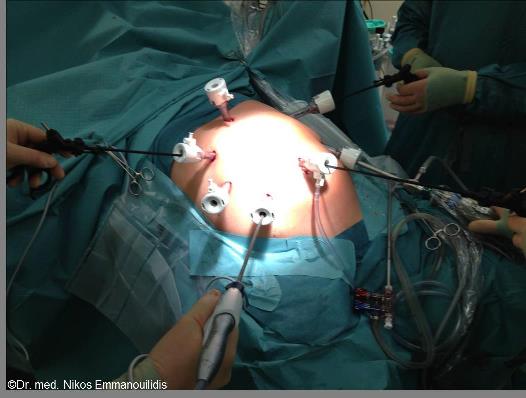 Endoskopischer Eingriff der Speiseröhre, vom Patienten ist nur der Bauch zu sehen, der Rest ist abgedeckt