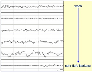 EEG-Veränderungen vom Wachzustand bis zur sehr tiefen Narkose.