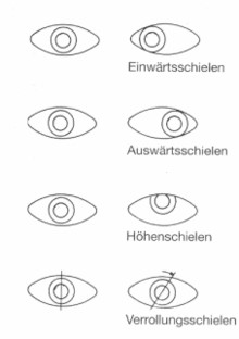 Verschiedene Schielformen wie z.B. Außenschielen und Innenschielen