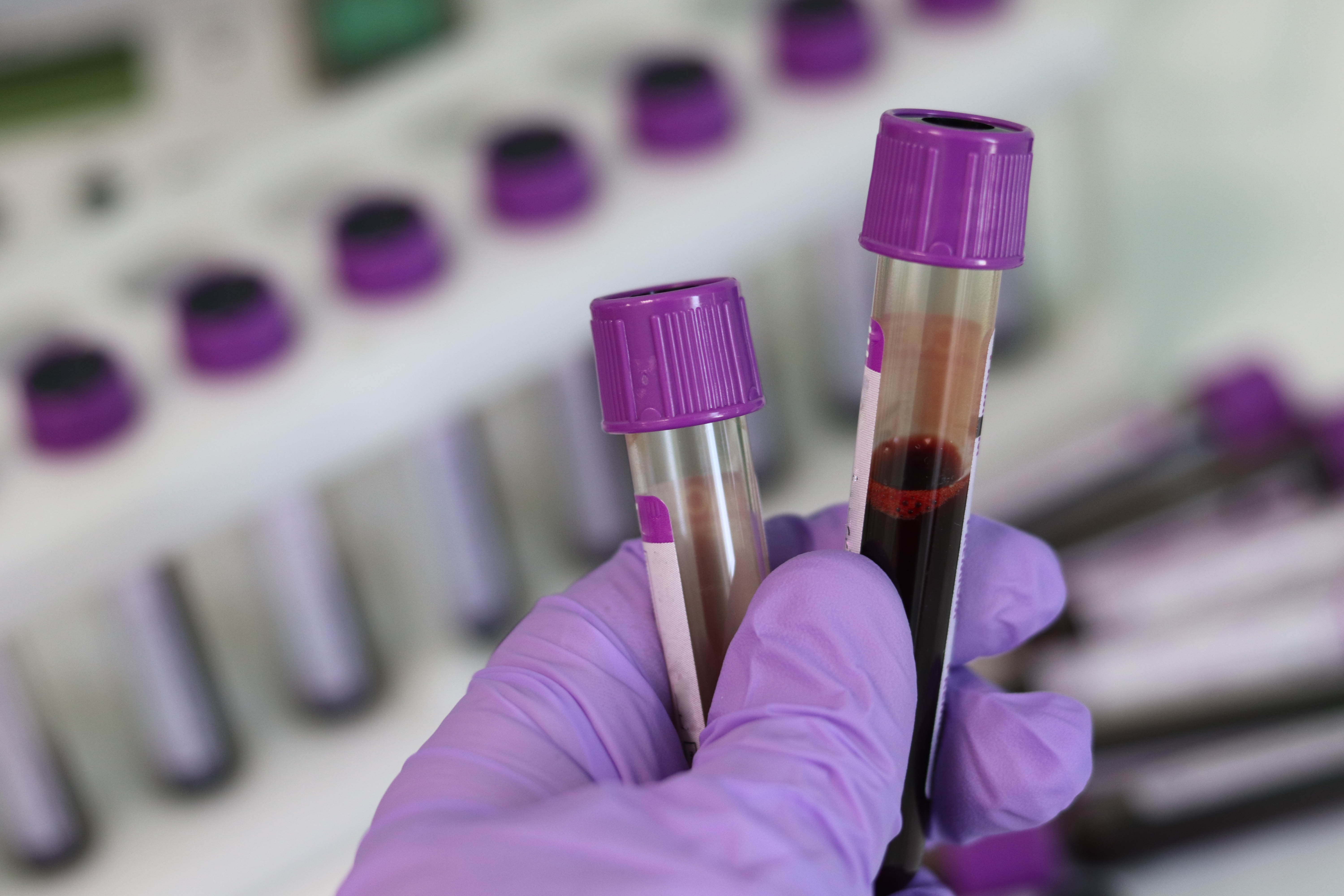 Laborröhrchen mit Blut Lila Handschuhe halten lila Laborröhrchen mit Blut