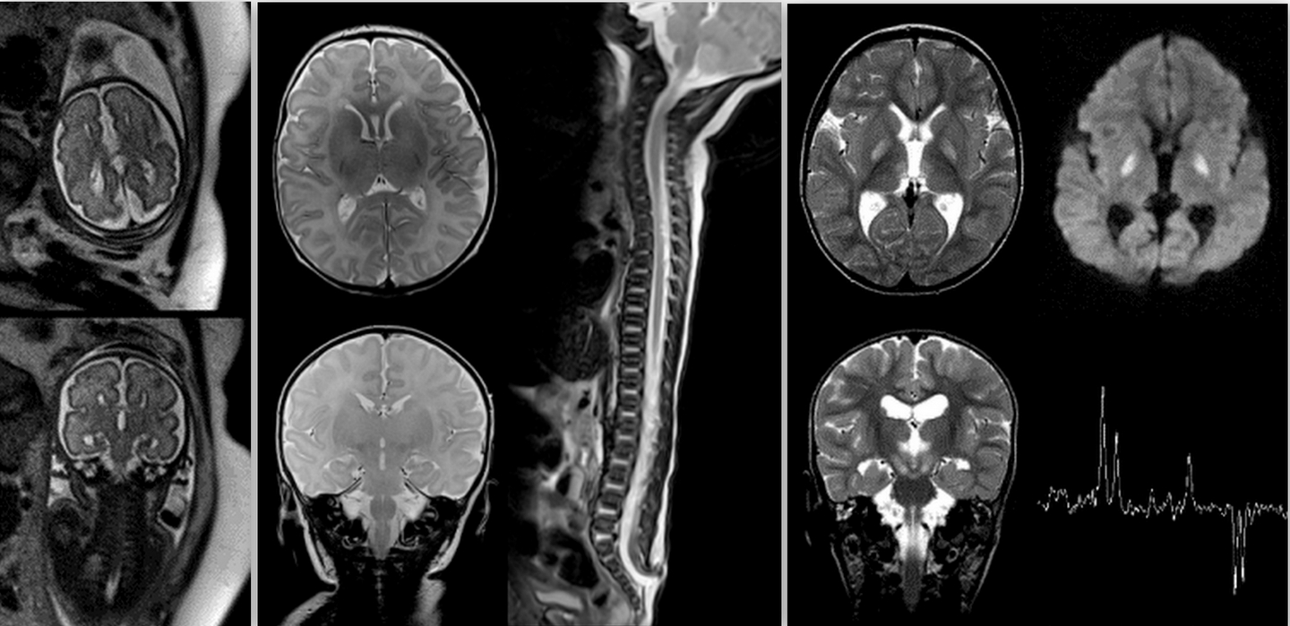 © Eva Bültmann/Neuroradiologie/MHH