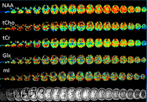 Copyright: Ding, Xiaoqi/Neuroradiologie/MHH