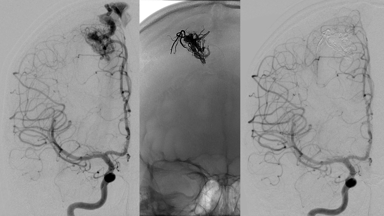 © Dan Meila/Neuroradiologie/MHH © Dan Meila/Neuroradiologie/MHH