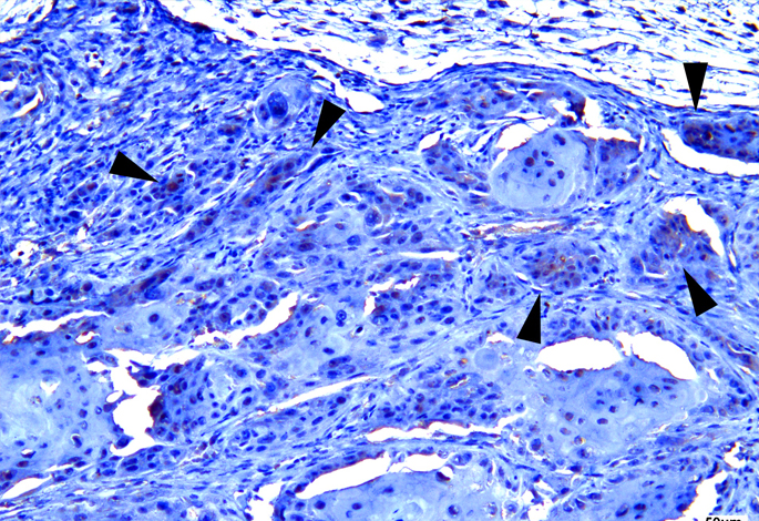 Histologische Untersuchung von Tumorgewebe (Plattenepithelkarzinom). Nachgewiesen wurde der Marker „epithelial cell adhesion molecule“ (EpCAM, braune Färbung, siehe Pfeile im Bild). EpCAM ist ein Zelladhäsionsmolekül, das auf der Zelloberfläche von Epithelzellen zu finden ist und unter anderem Zell-Zell-Kontakte vermittelt.