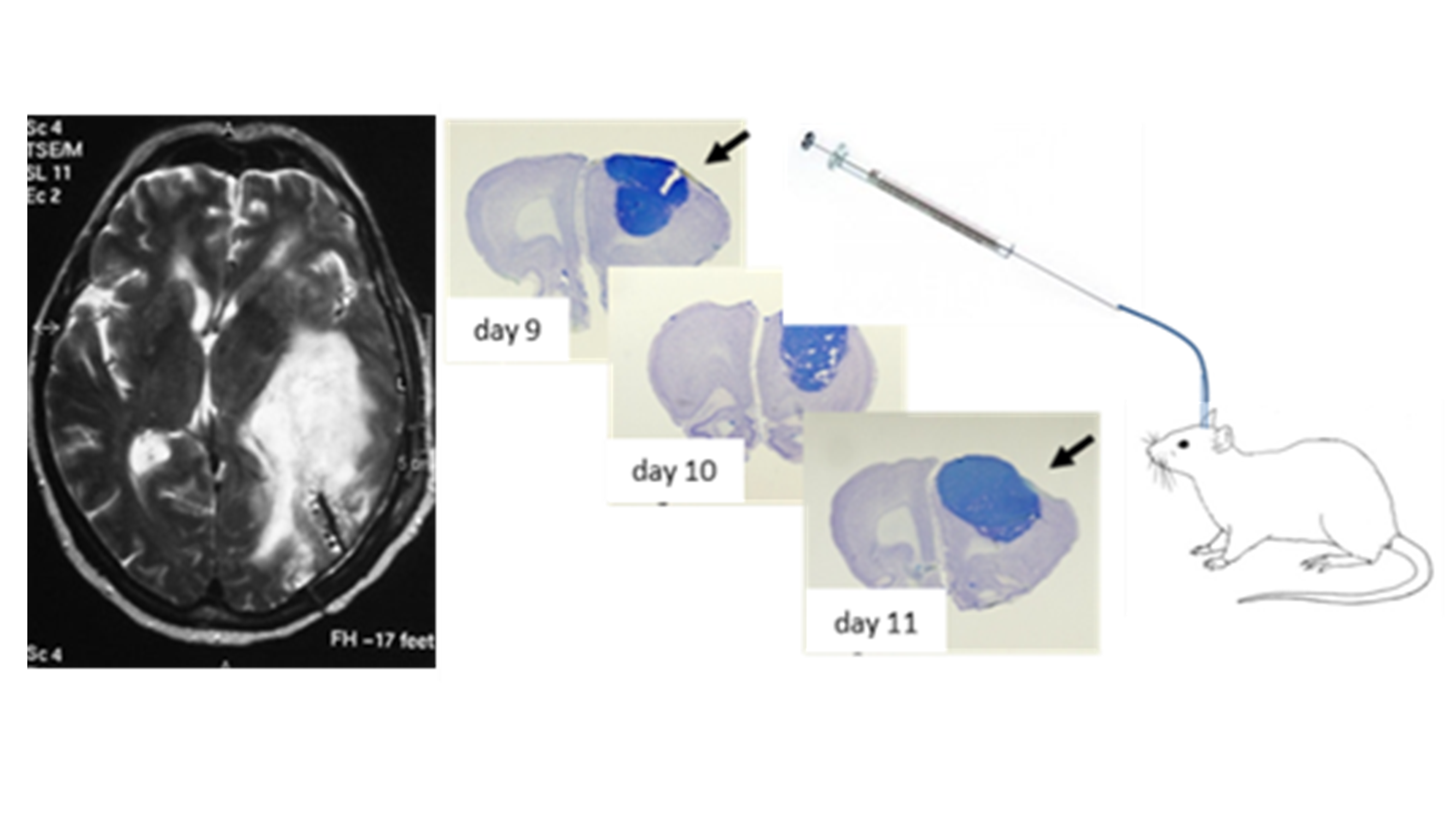 Humanes MRT Bild mit Tumor im Kopf, Fotos von Rattengehirnschnitten mit Tumor
