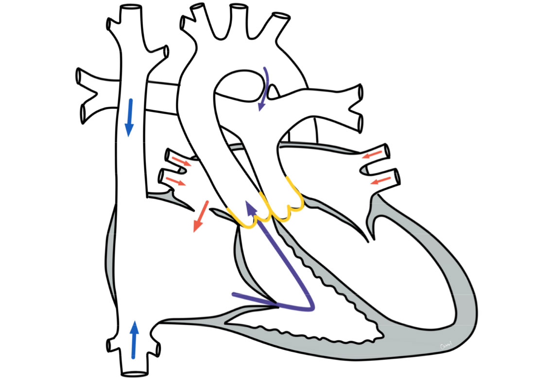 Medizinische Hochschule Hannover Transposition Der Grossen Arterien Tga