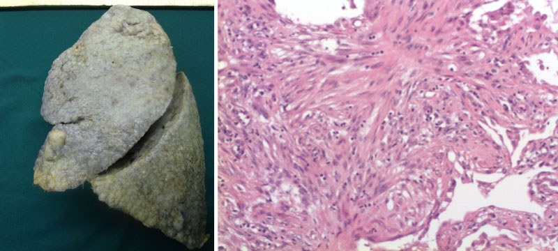 Copyright: Prof. D. Jonigk, Pathologie, MHH Copyright: Prof. D. Jonigk, Pathologie, MHH