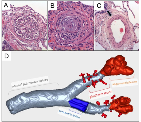 Copyright: Prof. D. Jonigk, Pathologie, MHH Copyright: Prof. D. Jonigk, Pathologie, MHH