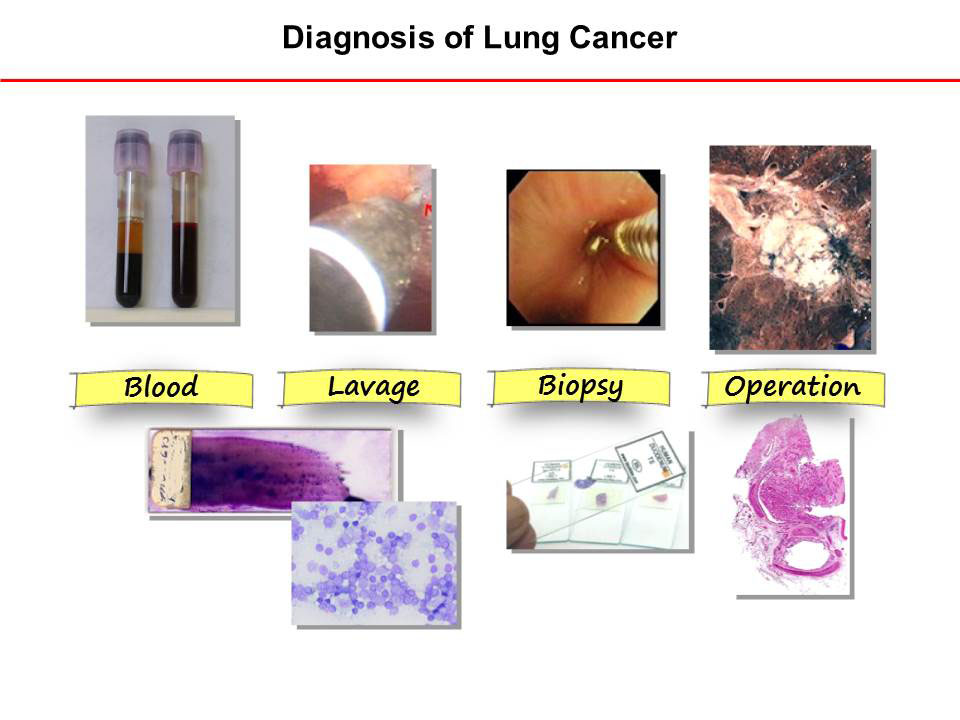 Copyright: Prof. D. Jonigk, Pathologie, MHH Copyright: Prof. D. Jonigk, Pathologie, MHH