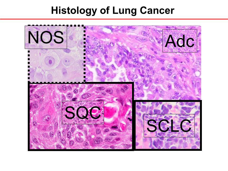 Copyright: Prof. D. Jonigk, Pathologie, MHH Copyright: Prof. D. Jonigk, Pathologie, MHH