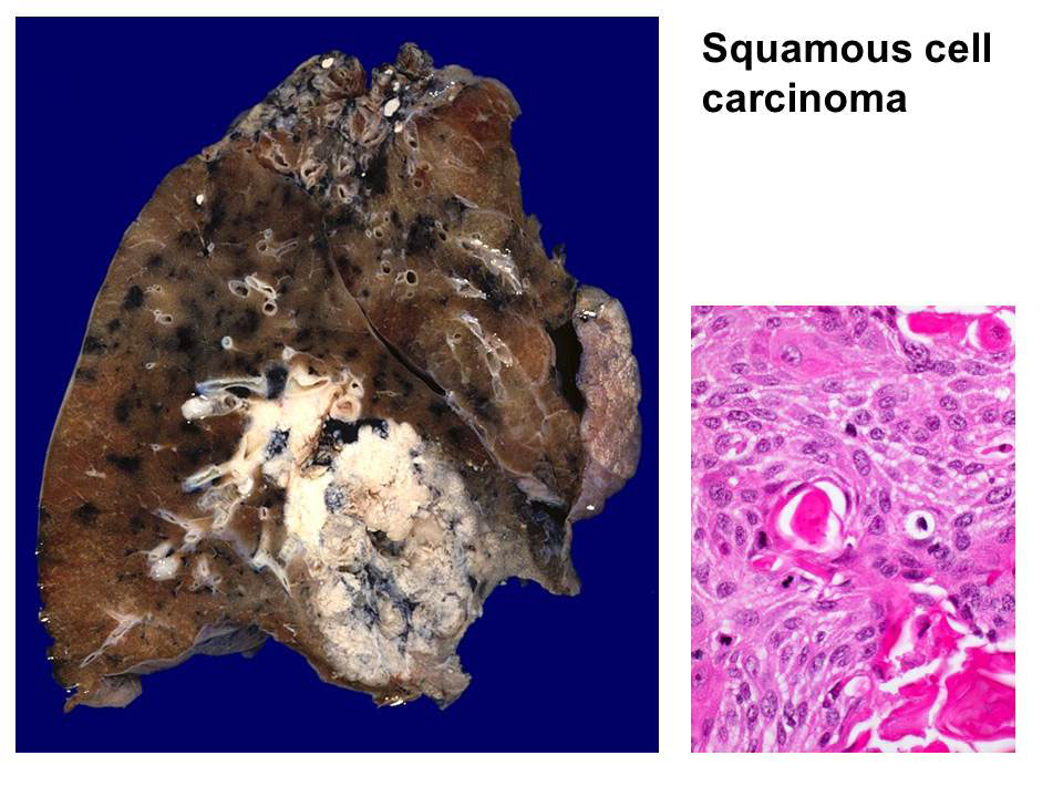 Copyright: Prof. D. Jonigk, Pathologie, MHH Copyright: Prof. D. Jonigk, Pathologie, MHH
