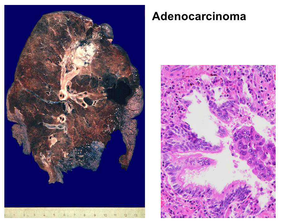 Copyright: Prof. D. Jonigk, Pathologie, MHH Copyright: Prof. D. Jonigk, Pathologie, MHH