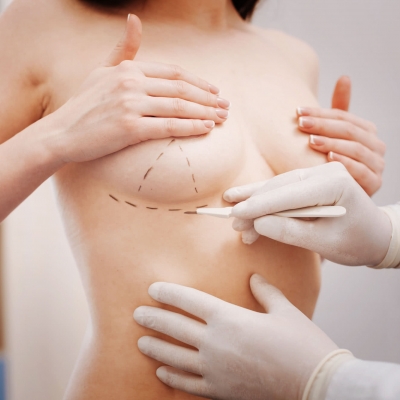 Chirurg zeichnet an der Brust einer Patientin für die OP vor.