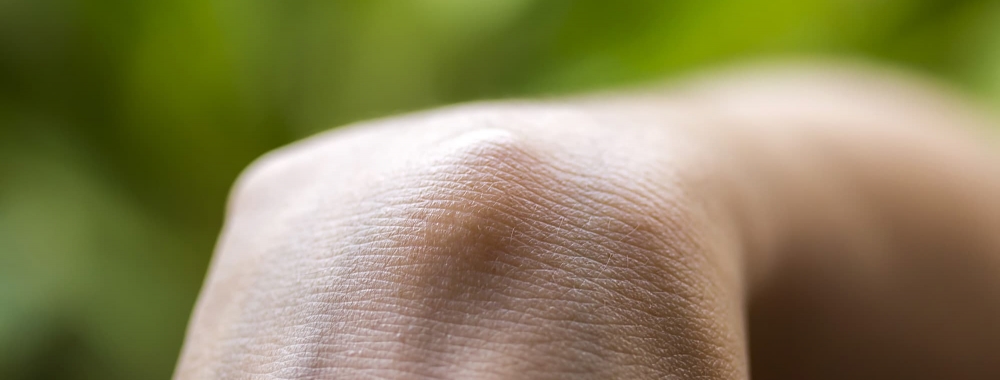 Bild eines sichtbaren Ganglions an der Hand