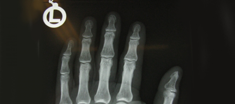 Röntgenbild einer linken Hand