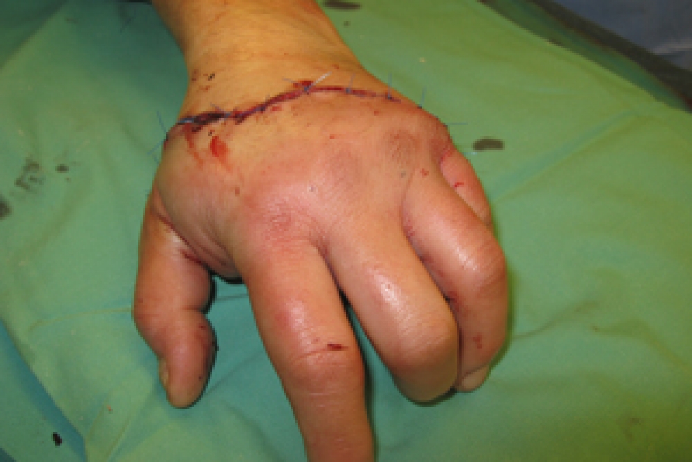 Mikrochirurgische Wiederanpflanzung einer Hand nach unfallbedingter Amputation durch eine Kreissäge bei Heimwerkerarbeiten.