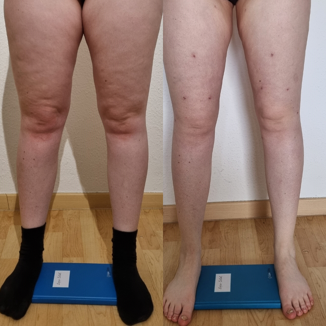 Medizinische Hochschule Hannover Leben Mit Lip dem Denise Bekommt 