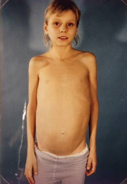 Barbara als Kind vor der Transplantation. Copyright: privat