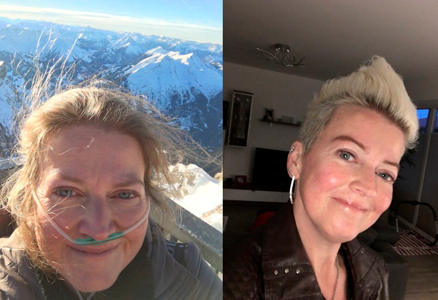 Kerstin Ronnenberg links vor Transplantation mit Beatmungsschlauch in der Nase. Rechts sieht man Kerstin auf einem aktuellen Foto Jahre nach der Transplantation. Sie sieht kerngesund aus. Copyright: Kerstin Ronnenberg