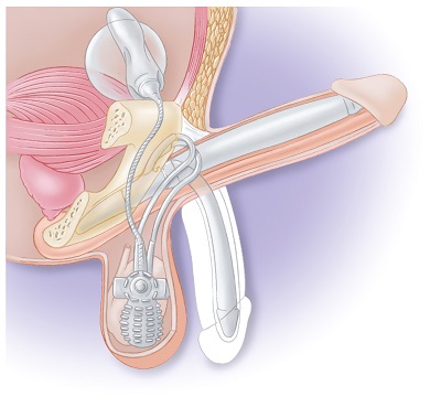 Ansicht der eingebauten Prothese, Copyright: AMS Medical Solutions