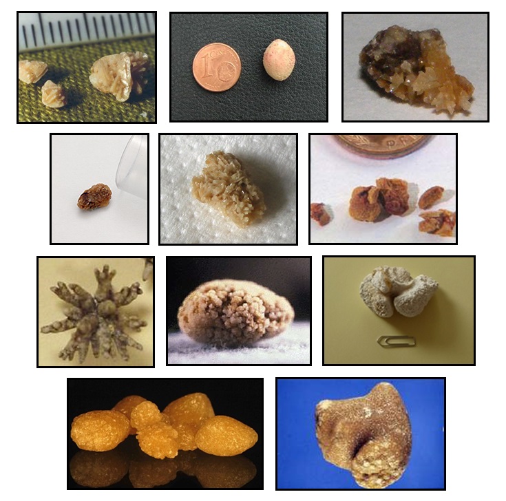 Verschiedene Nierensteine, Copyright: Klinik für Urologie/MHH