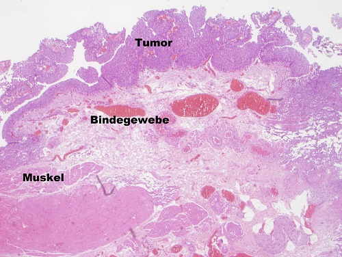 Komplette Tumorentfernung durch En-bloc-Resektion; alle Schichten bleiben erhalten, Copyright: Klinik für Urologie/MHH