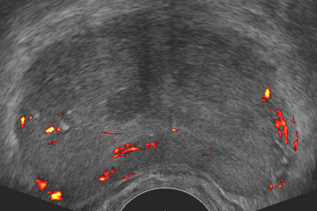 Analysierte Ultraschallbilder dieser Prostata Analysierte Ultraschallbilder dieser Prostata, Copyright: Klinik für Urologie/MHH