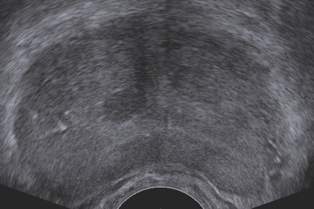 Ultraschallbild eines Prostataquerschnitts, Copyright: Klinik für Urologie/MHH