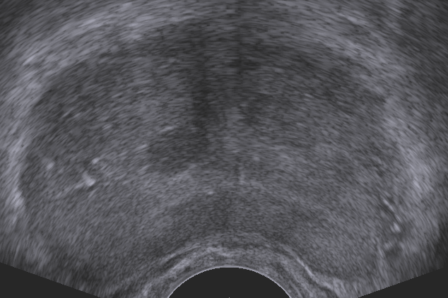 Ultraschallbild eines Prostataquerschnitts Ultraschallbild eines Prostataquerschnitts, Copyright: Klinik für Urologie/MHH
