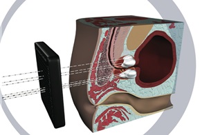 Fokale Therapie Fokale Therapie, Copyright: Klinik für Urologie/MHH